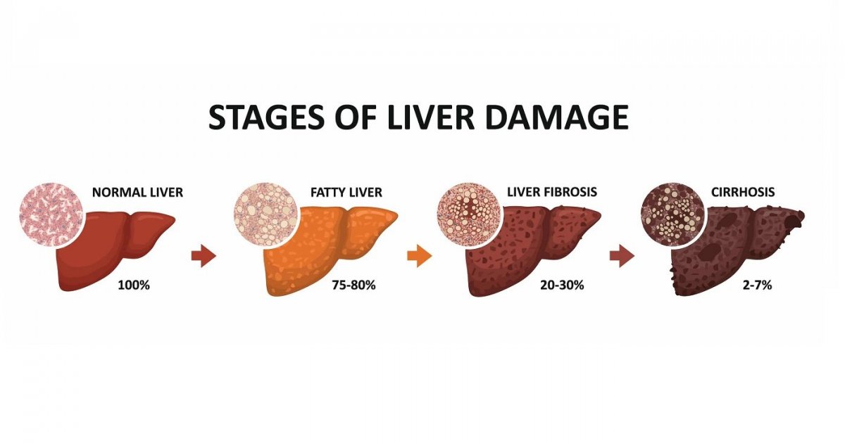 Staging Fibrosis In Chronic Viral Hepatitis